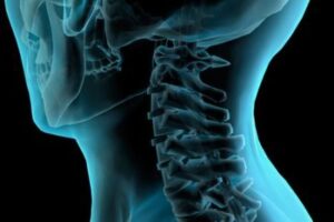 Des Moines Spinal Cord Injury Lawyers