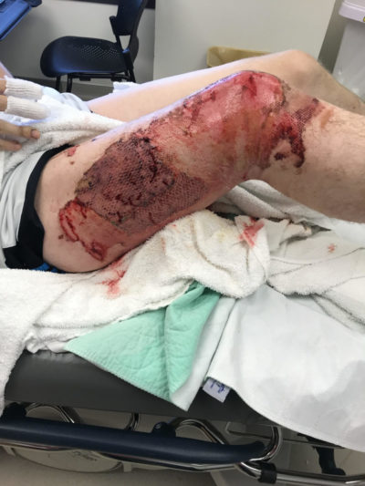 Des Moines E Cigarette Explosion Lawyer