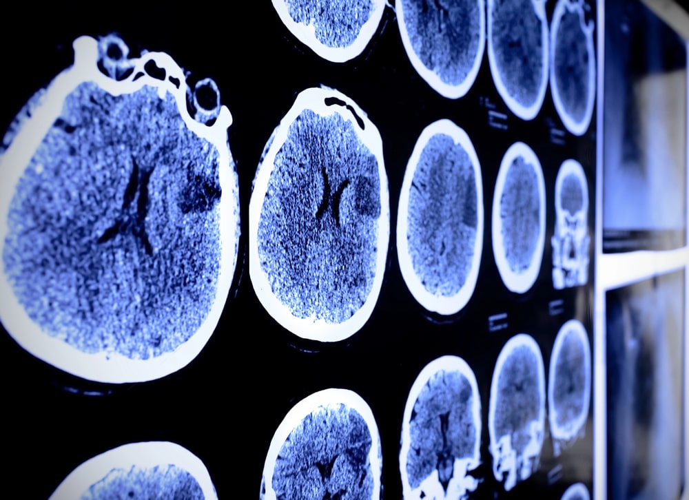 Iowa brain injury lawyer