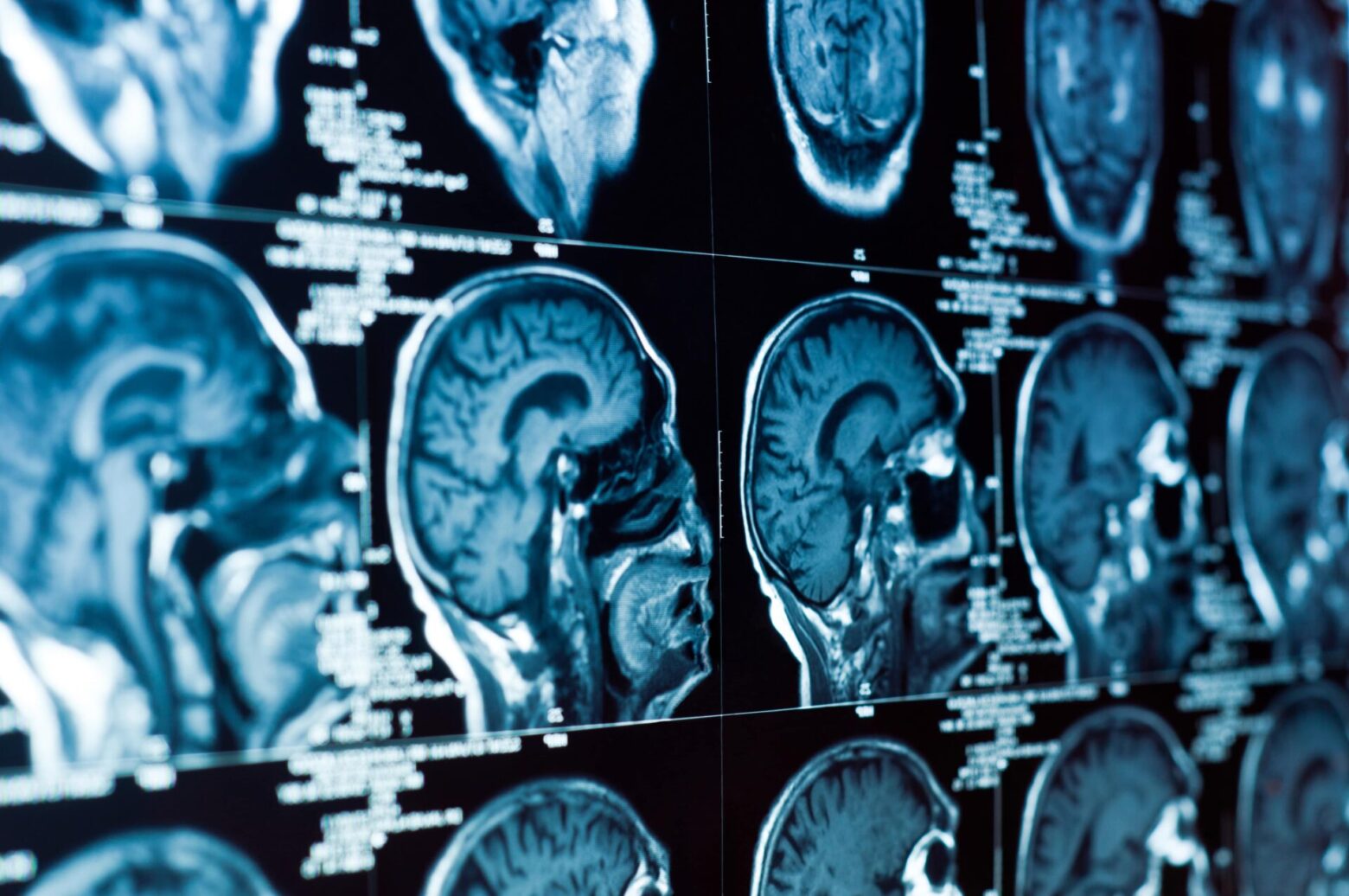 brain injury lawyer Iowa