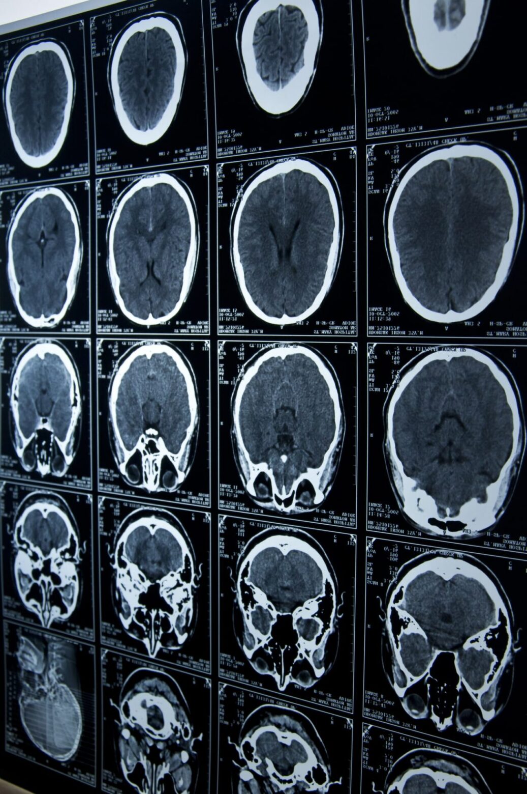 brain injury lawyer Iowa
